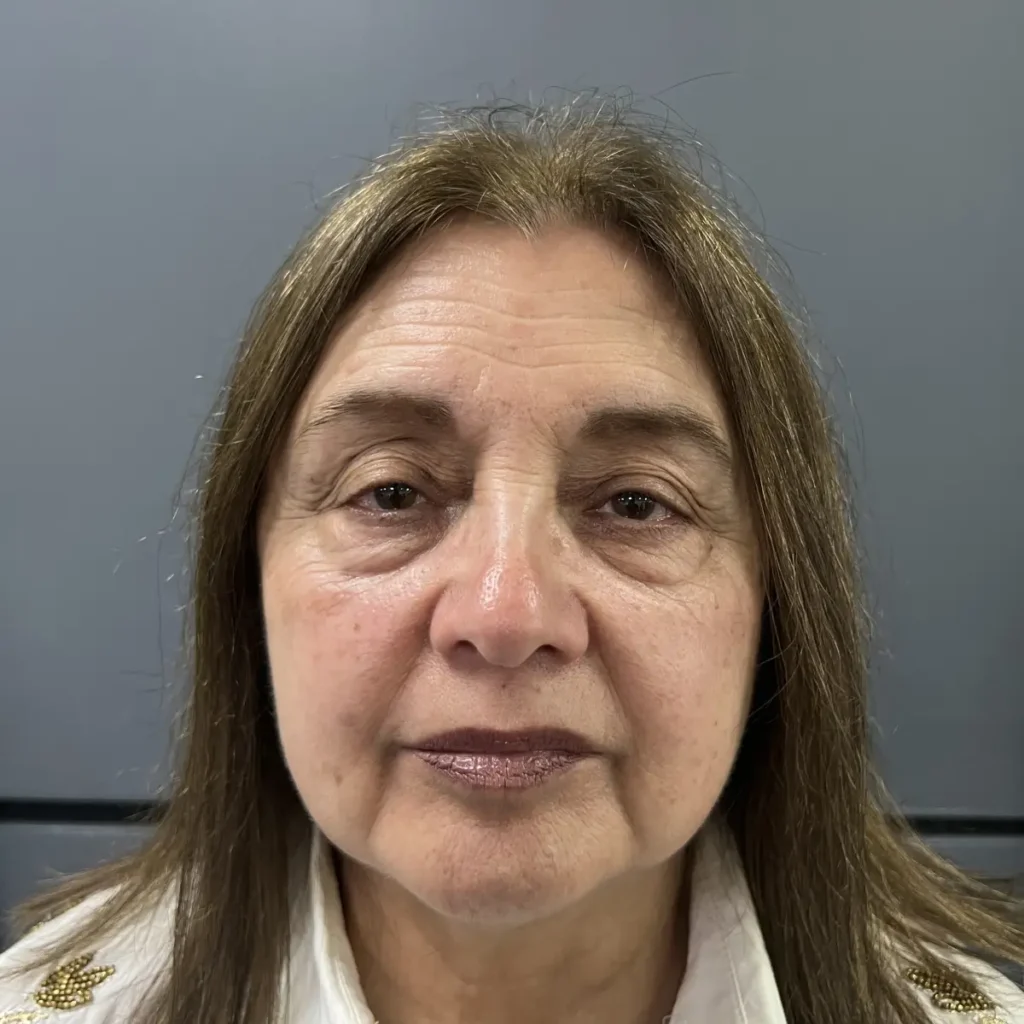 Lifting Facial Sin Cirugía (Cita de Evaluación)   Imagen 2